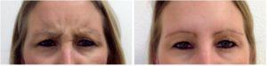 Botox For Forehead By Dr. Sacha Obaid, Plastic Surgeon In Southlake, Texas (3)