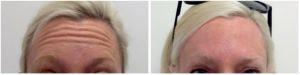 Botox For Forehead By Onna Feuchter, Injector, Skin, And Laser Specialist In Southlake, Texas