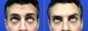 Botox For Forehead Lines And Dypsort By Dr Gregory Barron, MD, Stuart Dermatologic Surgeon