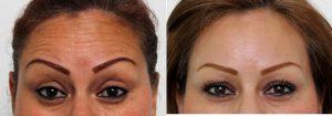 Botox For Forehead Lines By Dr. Amy K. Hsu, MD, Beverly Hills Facial Plastic Surgeon