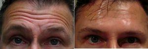 Botox For Forehead Lines By Dr. Yoash R. Enzer, MD, FACS, Providence Oculoplastic Surgeon