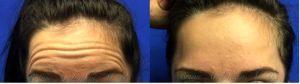 Botox For Forehead Wrinkles By Dr. Brian Arslanian, Plastic Surgeon In Atlanta, GA