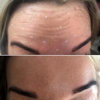 Botox For Forehead Wrinkles Price