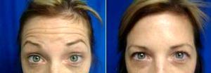 Botox For Forehead Wrinkles With Dr. Brian Windle, MD, Kirkland Plastic Surgeon