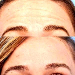 Botox For Forehead by Dr. Steven H. Dayan, MD, Doctor in Chicago, Illinois