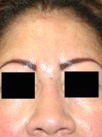Botox For Frown Line (glabella) With Dr Harold J. Kaplan, MD, Los Angeles Facial Plastic Surgeon