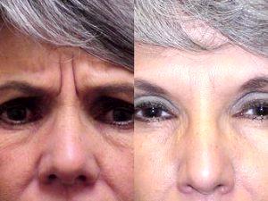 Botox For Frown Lines Before And After By Dr John W. Bass, MD, Phoenix Plastic Surgeon