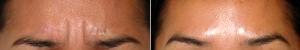 Botox For Glabella '11's' By Doctor Victor Lacombe, MD, Santa Rosa Facial Plastic Surgeon