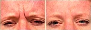 Botox For Glabella Lines by Dr. Steven H. Dayan, MD, Doctor in Chicago, Illinois (1)