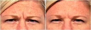 Botox For Glabella Lines by Dr. Steven H. Dayan, MD, Doctor in Chicago, Illinois (2)