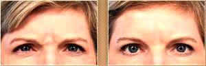 Botox For Glabella Lines by Dr. Steven H. Dayan, MD, Doctor in Chicago, Illinois