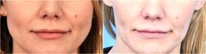 Botox For Masseters by by Dr. Steven H. Dayan, MD, Doctor in Chicago, Illinois (2)