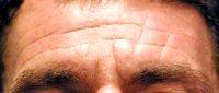 Botox For Men By Doctor Nissan Pilest, MD, Irvine Dermatologic Surgeon
