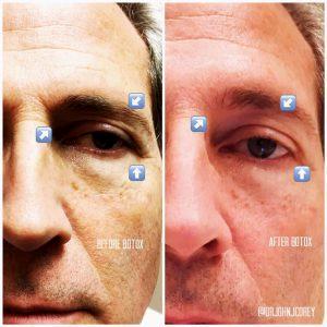 Botox For Men By Scottsdale Plastic Surgeon, Dr. John J. Corey, MD