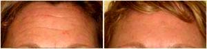 Botox For The Entire Forehead Lines By Boston Plastic Surgeon, Dr. Daniel Del Vecchio
