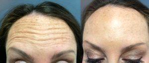 Botox For The Wrinkles On Her Forehead By Dr. Shaun Parson, Plastic Surgeon In Scottsdale, Arizona