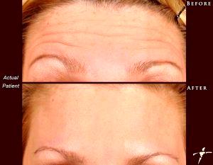 Botox For Treating Lines And Wrinkles On The Forehead By Dr. Nick Slenkovich, MD, Littleton CO Plastic Surgeon
