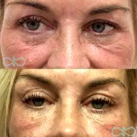 Botox For Under Eye Wrinkles And Crow's Feet