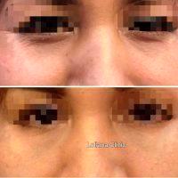 Botox For Under Eye Wrinkles Before And After Photo