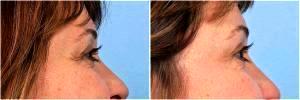 Botox For Women by Dr. Steven H. Dayan, MD, Doctor in Chicago, Illinois (1)