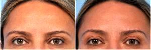 Botox For Women by Dr. Steven H. Dayan, MD, Doctor in Chicago, Illinois (10)