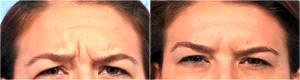 Botox For Women by Dr. Steven H. Dayan, MD, Doctor in Chicago, Illinois (2)