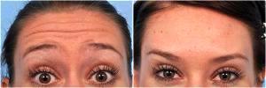 Botox For Women by Dr. Steven H. Dayan, MD, Doctor in Chicago, Illinois (5)