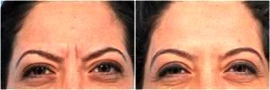 Botox For Women by Dr. Steven H. Dayan, MD, Doctor in Chicago, Illinois (7)