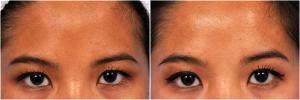 Botox For Women by Dr. Steven H. Dayan, MD, Doctor in Chicago, Illinois (9)