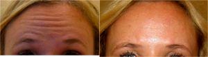 Botox Forehead At Always Beautiful Medspa, Medical Spa In Aurora, Colorado