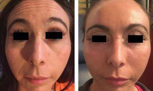 Botox Forehead At Just Face It MedSpa, Medical Spa In The Clark County, Nevada