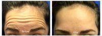 Botox Forehead Creases Before And After