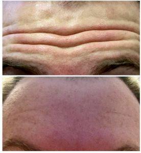 Botox Forehead Deep Lines Before And After