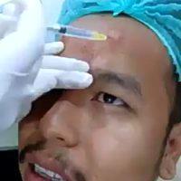Botox Forehead Injections For Men