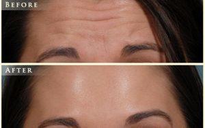 Botox Forehead Lines By Dr. Nick Slenkovich, MD, Littleton CO Plastic Surgeon (1)