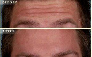 Botox Forehead Lines By Dr. Nick Slenkovich, MD, Littleton CO Plastic Surgeon (2)
