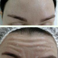Botox Forehead Results Before And After