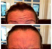 Botox Forehead Wrinkles Before And After Pic