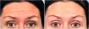 Botox Forehead lines by Dr. Steven H. Dayan, MD, Doctor in Chicago, Illinois