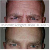 Botox Frown Lines By Jessica Abiagom