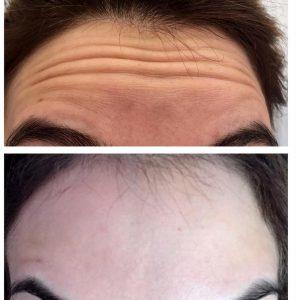 Botox Horizontal Forehead Lines Before And After (1)