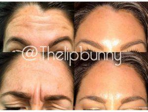 Botox Horizontal Forehead Lines Before And After (4)