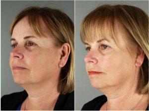 Botox In Between Her Eyebrows, Crow's Feet By Patti Flint MD PC, MD, Scottsdale AZ Plastic Surgeon (1)