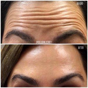 Botox In Forehead Without Any Brow Droop By Scottsdale Plastic Surgeon, Dr. John J. Corey, MD