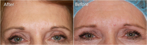 Botox In Glabella Creases By Dr. Tri Nguyen, Dermatologist In Houston, TX