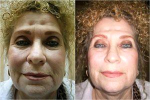 Botox In Her Frown Lines, Glabella , And Crows Feet By Dr. Thomas Jeneby