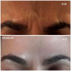 Botox In The Glabella (for Frown Lines) By Scottsdale Plastic Surgeon, Dr. John J. Corey, MD