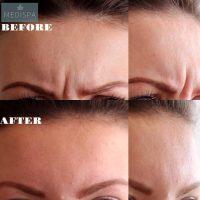 Botox In Your Frown Lines Before And After