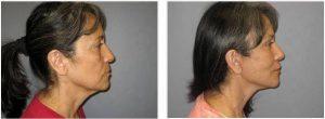 Botox Injected Into Her Brow To Reduce Brow Wrinkling By Dr. Steven Vath, Denver Cosmetic Plastic Surgeon