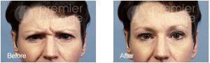 Botox Injected To The Glabella Frown Lines By Kristin A. Boehm, M.D., FACS, Plastic Surgeon In Atlanta, GA